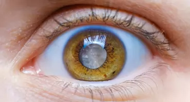 Operacja jaskry – kiedy jest potrzebna i jak się do niej przygotować